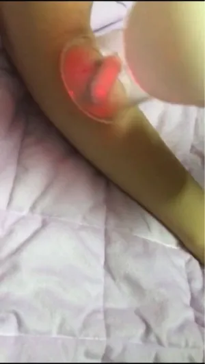 Aspirateur de cellulite
