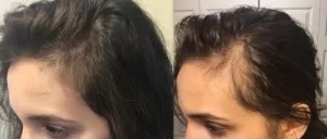 Sérum de repousse des cheveux en Roll-on