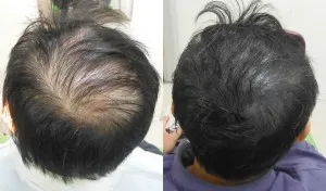 Sérum de repousse des cheveux en Roll-on