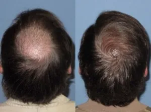 Sérum de repousse des cheveux en Roll-on