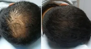 Sérum de repousse des cheveux en Roll-on