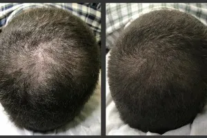 Sérum de repousse des cheveux en Roll-on