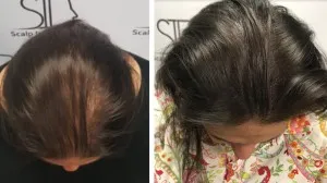 Sérum de repousse des cheveux en Roll-on