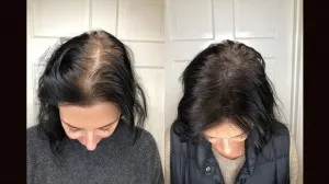 Sérum de repousse des cheveux en Roll-on