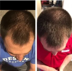 Sérum de repousse des cheveux en Roll-on
