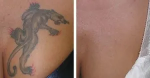 Stylo Laser Anti-taches