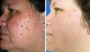 Stylo Laser Anti-taches