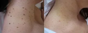 Stylo Laser Anti-taches