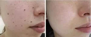 Stylo Laser Anti-taches
