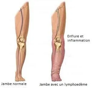 DRAINAGE LYMPHATIQUE HUILE DE GINGEMBRE DRAINAGE LYMPHATIQUE HUILE DE GINGEMBRE
