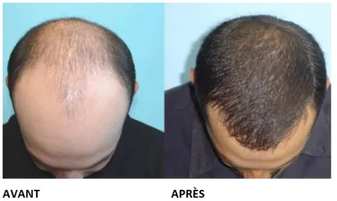 Sérum Capillaire à la Biotine Végétale Sérum Capillaire à la Biotine Végétale