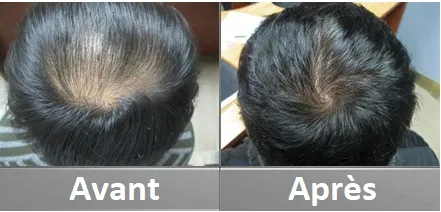 Sérum densité 100% naturel pour la croissance des cheveux Sérum densité 100% naturel pour la croissance des cheveux