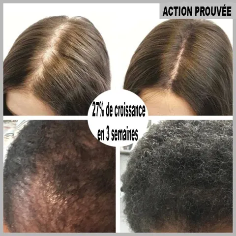 Sérum de repousse des cheveux en Roll-on