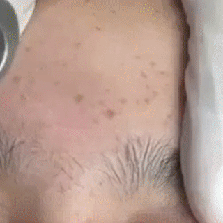 Stylo Laser Anti-taches